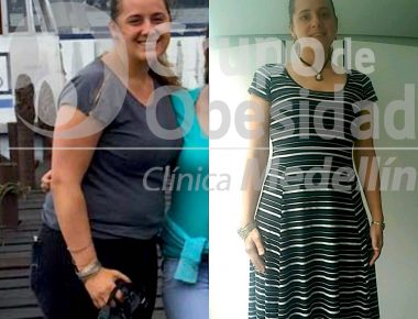 before and after gastric balloon