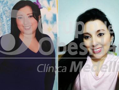 before and after gastric balloon