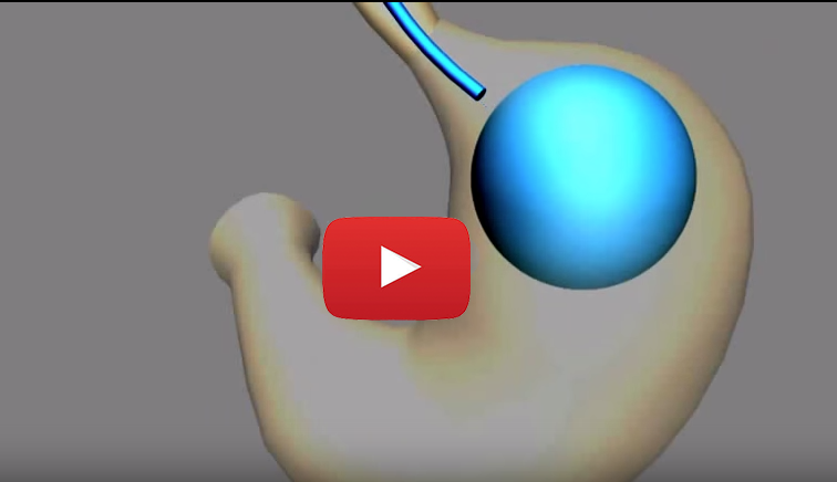 video procedimiento balon gastrico